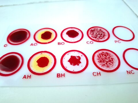Top view of a blood typing test kit slide showing agglutination reactions in circular wells for ABO and Rh blood group identification in laboratory.