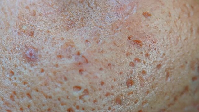 macro shot of human facial skin texture with enlarged pores and uneven surface.
