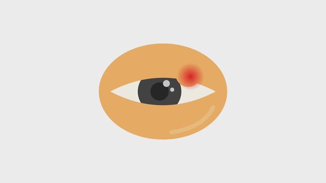 Stye on the eyelid, medical illustration of eye condition