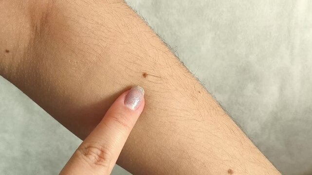 Woman examining moles on her hand and arm, illustrating skin self-examination, preventive dermatology and monitoring of skin changes.