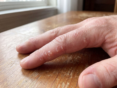Dyshidrotic Eczema Blisters on Finger Close Up