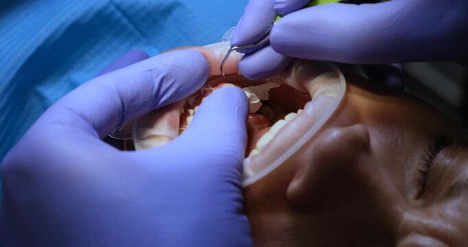 Experienced dentist places dental veneers on prepared teeth of patient. Doctor installs custom-made veneers onto teeth improving appearance