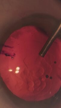 Professional ophthalmologist performing cataract removal and intraocular lens (IOL) implantation under a surgical microscope in an operating room.