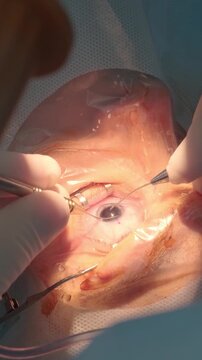 Professional ophthalmologist performing cataract removal and intraocular lens (IOL) implantation under a surgical microscope in an operating room.