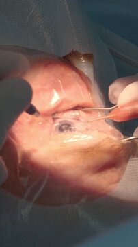 Professional ophthalmologist performing cataract removal and intraocular lens (IOL) implantation under a surgical microscope in an operating room.