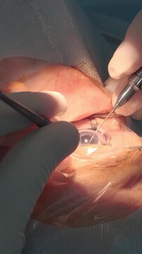 Professional ophthalmologist performing cataract removal and intraocular lens (IOL) implantation under a surgical microscope in an operating room.