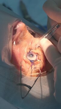 Professional ophthalmologist performing cataract removal and intraocular lens (IOL) implantation under a surgical microscope in an operating room.