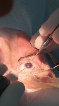Professional ophthalmologist performing cataract removal and intraocular lens (IOL) implantation under a surgical microscope in an operating room.