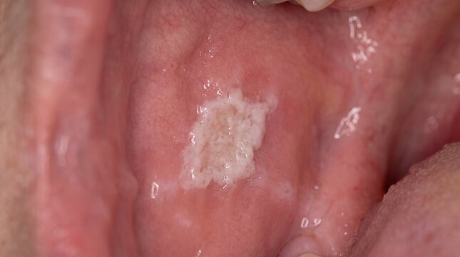 Periodontitis with Gingival Changes &ndash; Non-Graphic Clinical Background