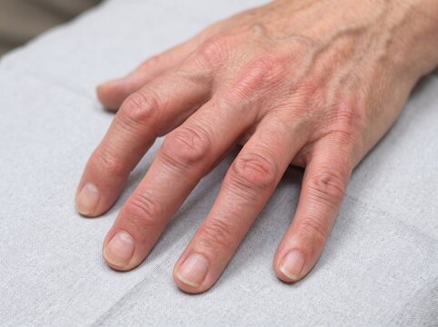 Inflammatory Arthritis with Red Swollen MCP and Interphalangeal Joints