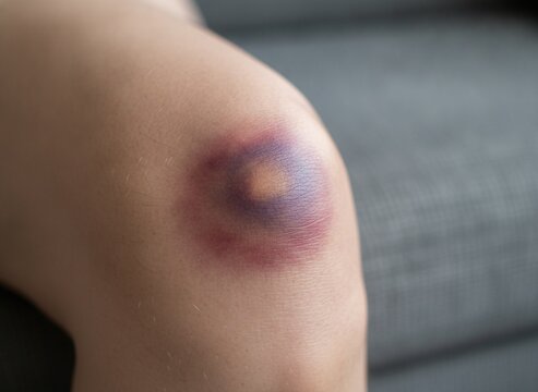 Close-up of a large purple and red bruise on a person's knee, concept of physical injury and trauma