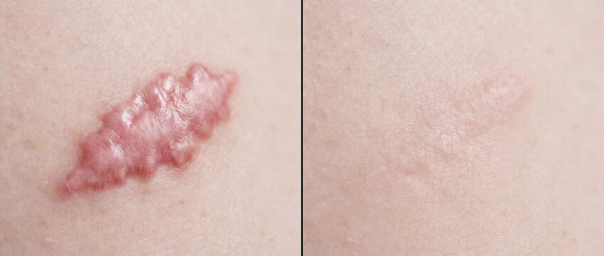 Keloid Scar Removal Comparison on Human Skin, Dermatological Before and After Healing Process Macro View