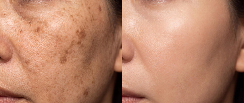 Melasma Hyperpigmentation Facial Treatment Before and After Result on Mature Woman Skin