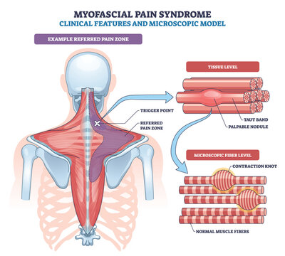 Myofascial pain syndrome diagram shows trigger point in trapezius with referred pain zone and taut band, linking back anatomy to microscopic contraction knots. Outline diagram