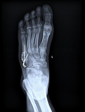 Anteroposterior AP radiograph of human foot showing metatarsals and phalanges anatomy.