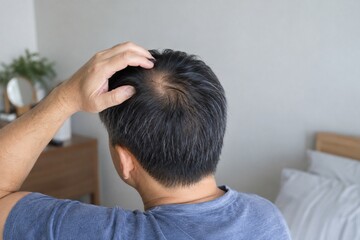 Fototapeta premium Man Scratching Itchy Scalp With Bald Spot on Crown