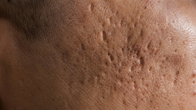 Macro photograph of atrophic acne scarring and deep pits on the cheek of an adult.