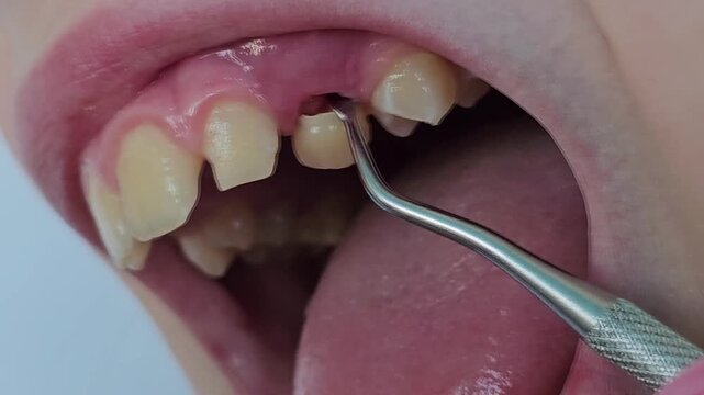 Extracting teeth in a dental clinic with a focus on the procedure and tools used
