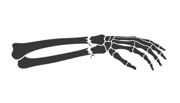 Dark grey silhouette of an arm and hand showing a broken bone at the wrist area for medical diagnosis and orthopedic injury information.