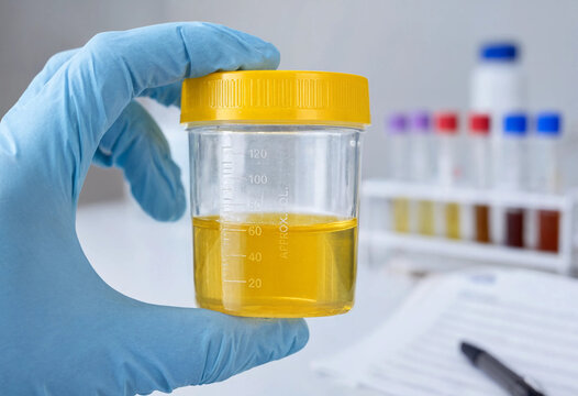 Laboratory Gloved Hand With Urine Sample Container
