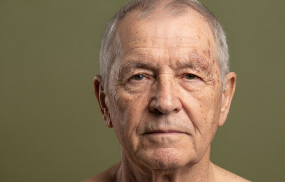 Frontal portrait of senior man with actinic keratosis and age spots on forehead