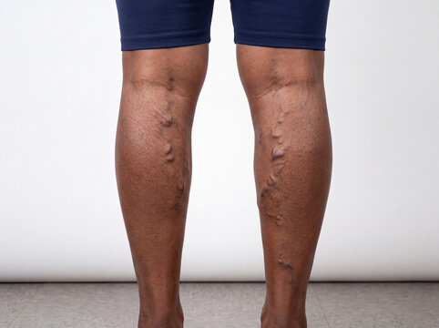 Varicose veins on African American legs close-up view isolated on white background. Severe swollen and twisted superficial veins on the calves of a Black patient with dark skin.