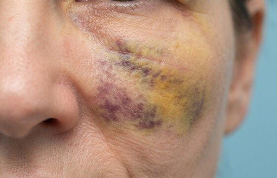 Extreme close up of woman cheek with severe yellow purple bruise and scratch mark