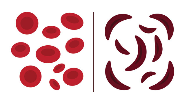 Sickle cell anemia vs healthy erythrocytes comparison flat vector illustration for hematology medical education