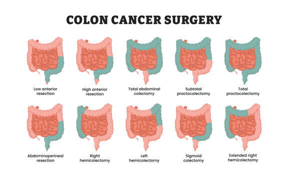 Colon cancer surgery labeled diagram, educational medical poster design healthcare scheme, bowel surgery colorectal resection procedure. Anterior resection colectomy, proctocolectomy and hemicolectomy