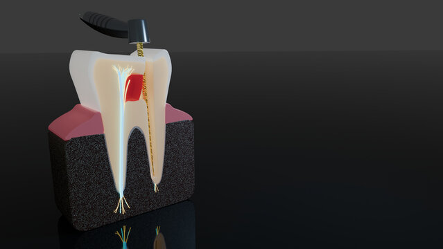 Macro view of distal root canal cleaned by endodontic file in tooth cross