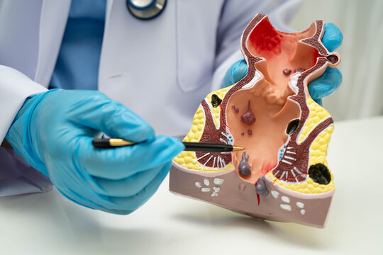 Colorectal cancer, doctor holding intestine colon human anatomy model.