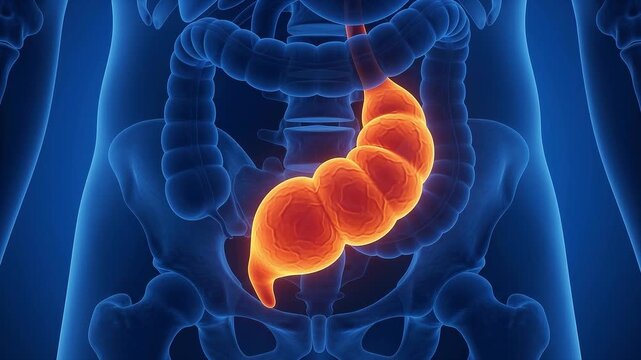 Medical illustration of acute appendicitis showing a severely swollen and inflamed glowing orange appendix attached to the deep blue colon.