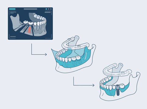 CBCT-Guided Dental Implant Planning Workflow from 3D Jaw Scan to Surgical Guide Placement