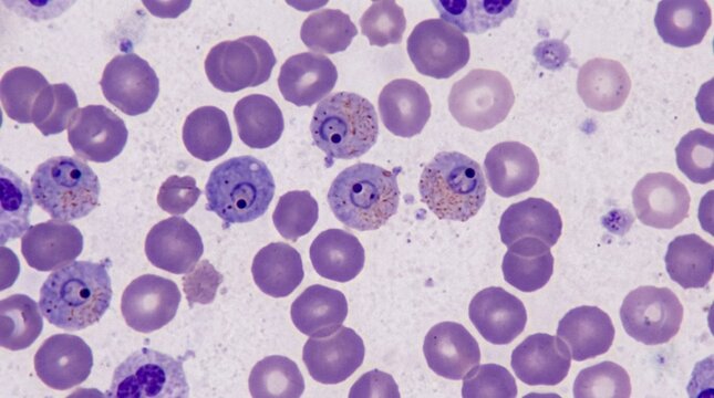 Malaria Parasite Infecting Red Blood Cells: Microscopic View