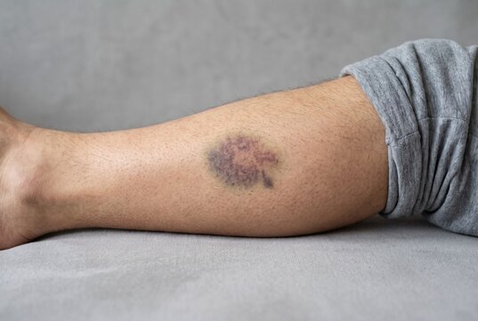 Close up of a human lower leg with a purple bruise on the shin