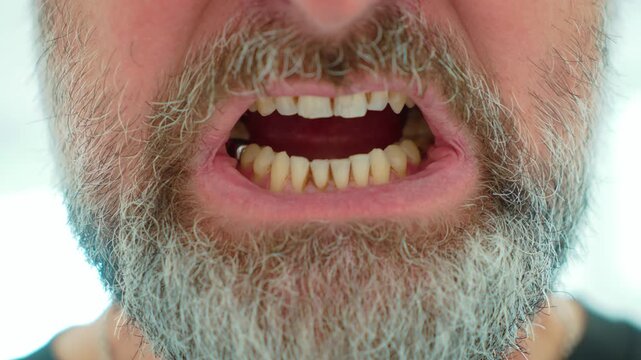 Adult man opening mouth with yellow teeth, visible plaque and dental calculus around gum line. Detailed close up of stained teeth and uneven enamel. Dental hygiene concerns, tartar buildup and oral