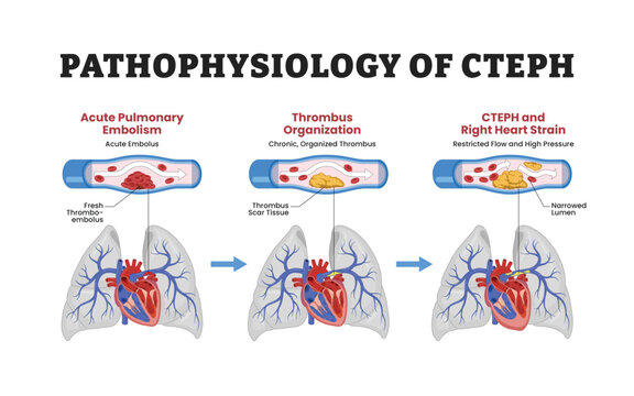 CTEPH pathophysiology labeled diagram, educational medical poster design healthcare scheme, thromboembolic progression. Acute pulmonary embolism thrombus organization narrowed lumen right heart strain