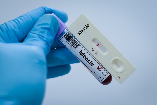 Blood sample tube of patient negative result for measle virus.