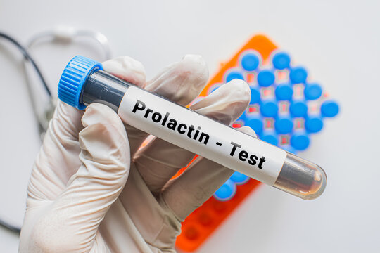Gloved hand holding Prolactin test blood tube with laboratory rack