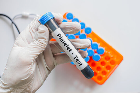 Gloved hand holding Platelet test blood tube with laboratory rack
