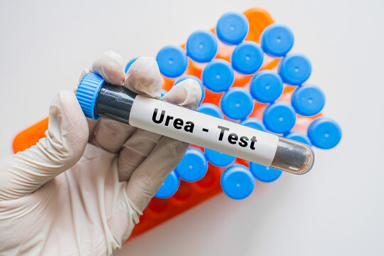 Gloved hand holding UREA test blood tube with laboratory rack