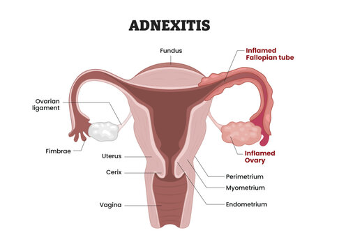 Adnexitis labeled diagram, educational medical poster design healthcare scheme, pelvic inflammatory disease. Labeled inflamed fallopian tube, inflamed ovary, uterus, cervix, fimbriae