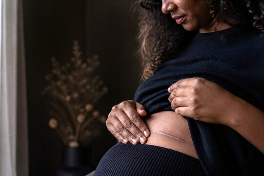 Woman reveals her abdominal scar with hands. She gently touches the skin near the healed incision. This image symbolizes body acceptance and postnatal recovery.