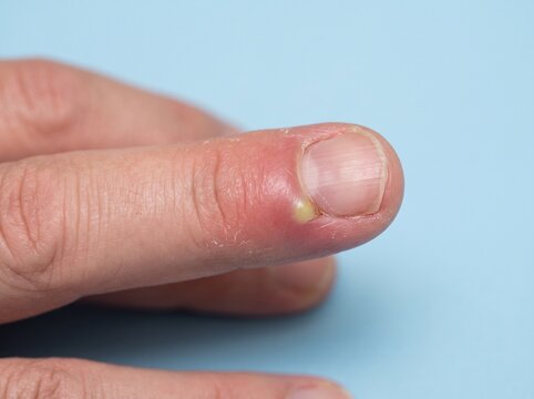 Acute Paronychia &ndash; Inflammation and Localized Infection of the Nail Fold