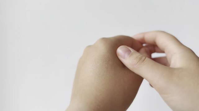 Horizontal video. Macro shot of dry, dehydrated skin on a person's hands, showing the cracked texture and the need for care.