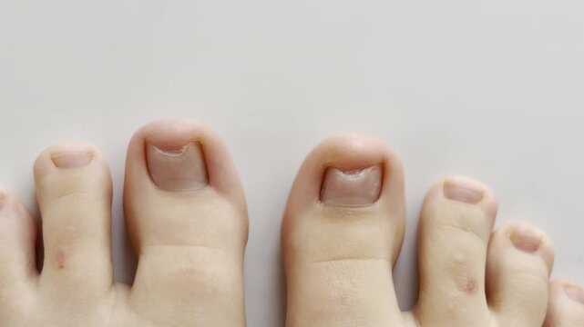 Horizontal video. Macro shot of a big toe during treatment for a fungal infection; details of nail care and the recovery process are shown.
