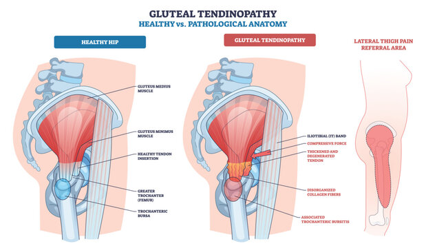 Gluteal tendinopathy anatomy compares healthy and pathological hip, highlighting gluteus medius, tendon insertion, and IT band with pain referral area. Outline diagram