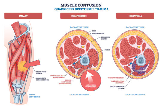 Quadriceps muscle contusion deep tissue trauma visualizes impact, compression, and hematoma with cross section views, key objects, thigh muscles, femur, intramuscular hematoma. Outline diagram