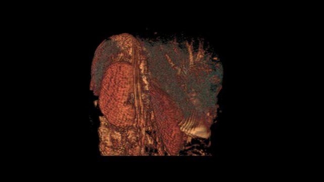 Coronal T2-Weighted SPAIR MRI Scan of Abdominal Organs