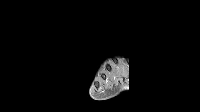 Posterior Coronal MRI View of Right Ankle and Heel Bone